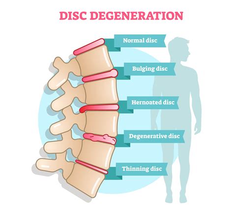 Lumbar Spine Degeneration Subluxation Anatomy Chiropractic Model | Hot Sex Picture