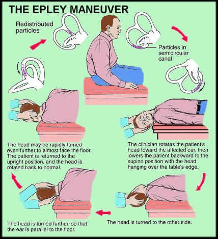 Epley Procedure At Home