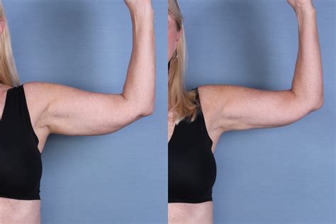 CoolSculpting - 65145 - Arms | Ocala Plastic Surgery