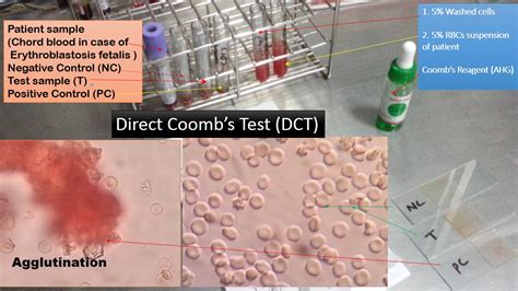 Direct Coomb Test (DCT): Introduction, Principle, Procedure, Result Interp