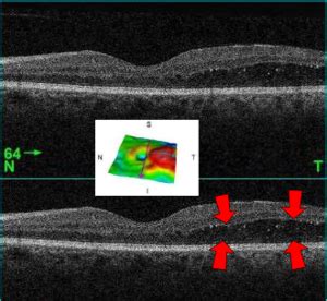 Macular edema - Wikipedia