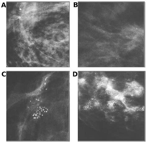 Calcifications with suspicious morphology. Digital zoom mammographic... | Download Scientific ...