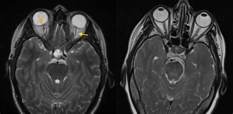 Benign intracranial hypertension - Radiology at St. Vincent's University Hospital