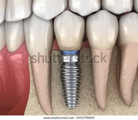 Premolar Tooth Recovery Implant Medically Accurate Stock Illustration ...