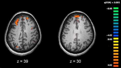 File:Schizophrenia fMRI working memory.jpg - Wikimedia Commons