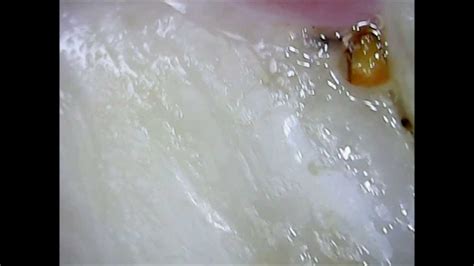 Teeth Plaque Under a Microscope (#DISGUSTING!) - YouTube