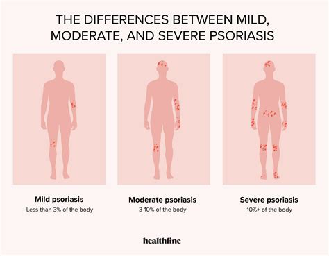 How to Spot Mild, Moderate, and Severe Psoriasis