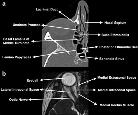 Axial CT (a) and T2-weighted MRI (b) showing the key landmarks of nasal ...