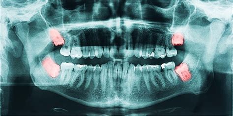 Wisdom Teeth Removal / Impacted Tooth Extraction - The procedure explained