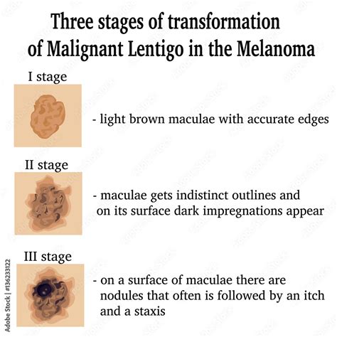 Malignant Melanoma Stages