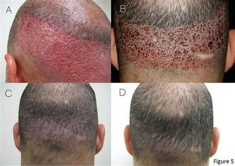 Fue Hair Transplant Surgery at best price in Ludhiana | ID: 8400969333