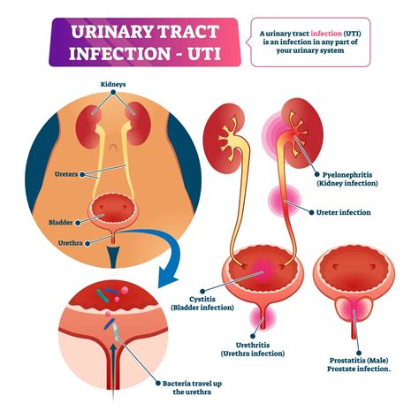 UTI Myths - Capital Women's Care of Rockville