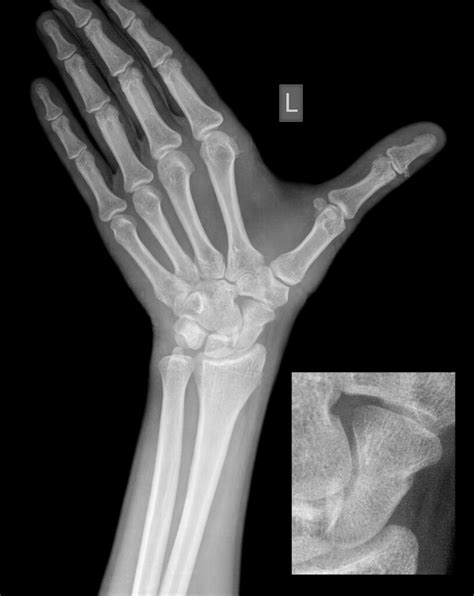 Scaphoid Fracture Treatment Melbourne & Gippsland