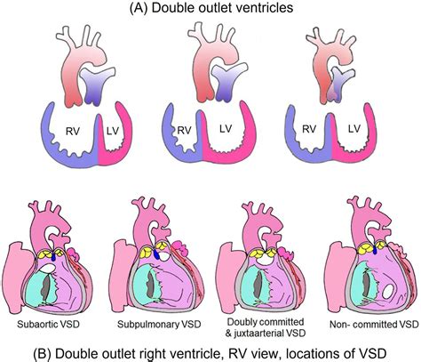 Double outlet ventricles: review of anatomic and imaging characteristics | Heart