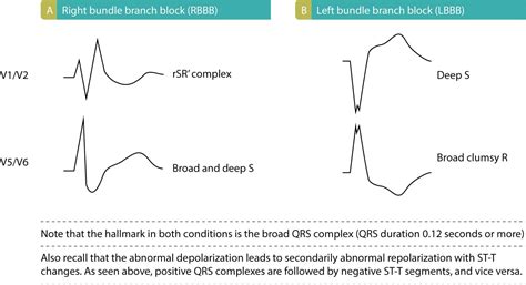 Left bundle branch block (LBBB): ECG criteria, causes, management – ECG learning