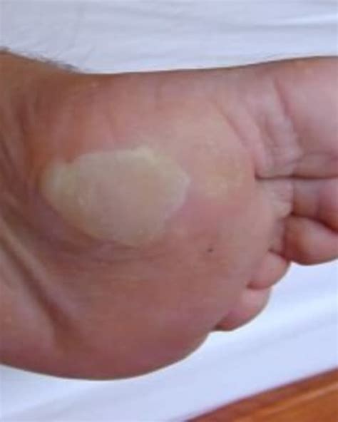 Leg Swelling (Edema) in the Elderly: Causes and Treatment - YouMeMindBody