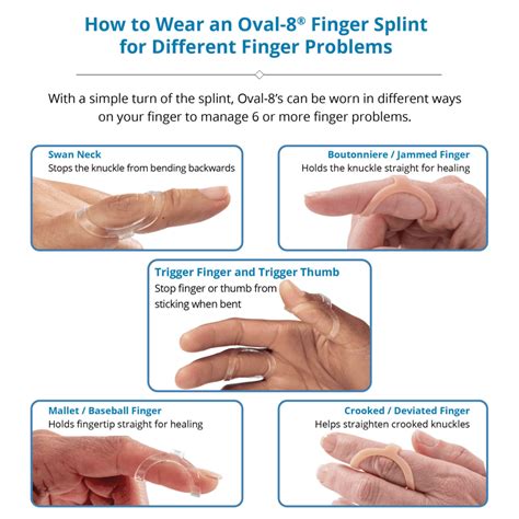 What Size Oval-8 Splint Do I Need? Ohmyarthritis.com Updated Oct 2023