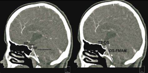 The distance between the tuberculum sellae and dorsum sellae (TS–DS),... | Download Scientific ...