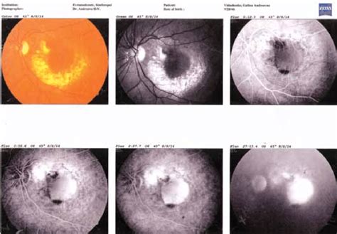 Fluorescein angiography of the left eye of the patient in the initial... | Download Scientific ...