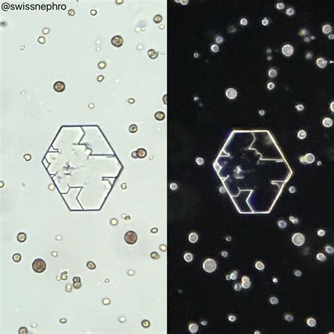 Urine Sediment of the Month: Cystine Crystals - Renal Fellow Network