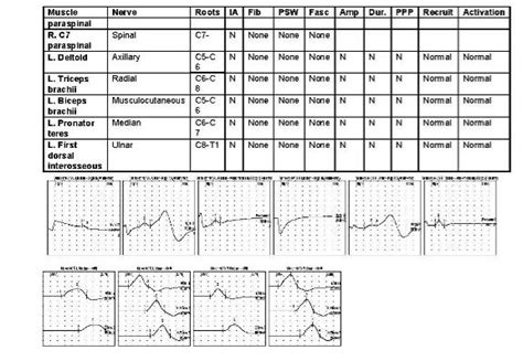 Who performs your EMG/NCV is more important than you may realize: - Legacy Spine & Neurological ...