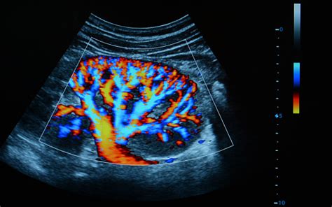 Kidney Ultrasound With Doppler Effect Stock Photo - Download Image Now ...