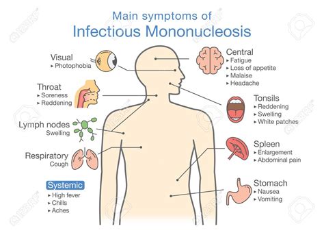 Causas De Mononucleosis Infecciosa | My XXX Hot Girl