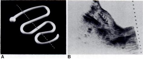 -A, Lippes Loop IUD en face. | Download Scientific Diagram