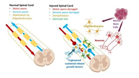 Spinal Cord Injury Program - Neural Stem Cell Institute, Rensselaer NY