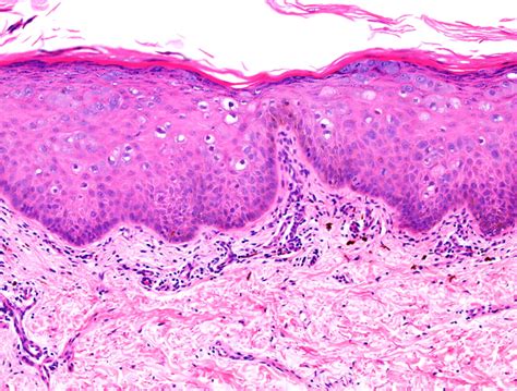 Punch biopsy of skin showing an acanthotic epidermis containing... | Download Scientific Diagram