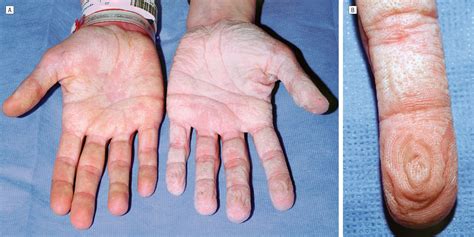 Aquagenic Wrinkling of the Palms in Patients With Cystic Fibrosis Homozygous for the ΔF508 CFTR ...