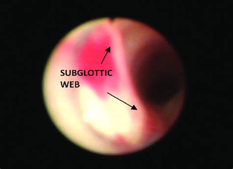 Laryngeal web on the posterior aspect of the larynx just below the ...