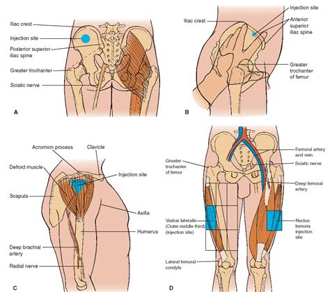 Intramuscular injection sites. (A) Dorsogluteal (posterior view): lateral, slightly superior to ...