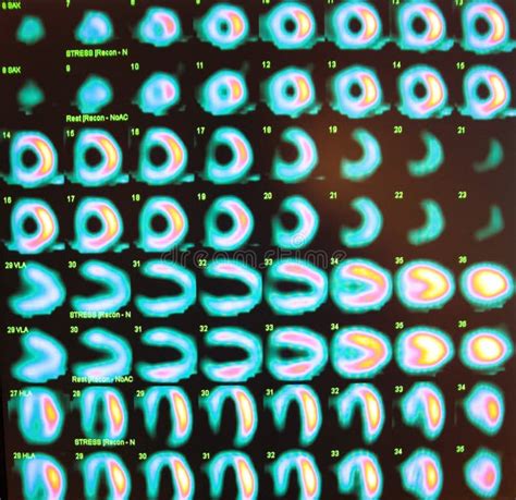 Stress Test,nuclear Medicine Stock Photo - Image of cardiology, rest: 30942152