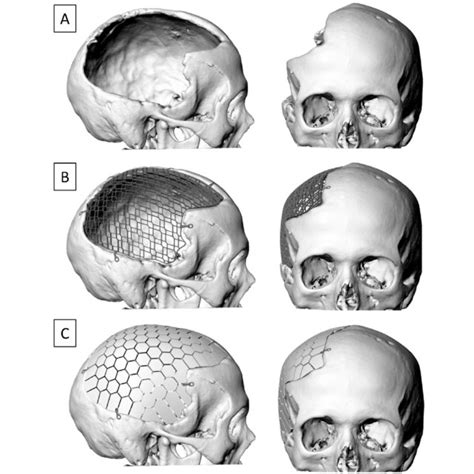 Images of 3D Reconstructions of Cranial Defect and Incorporated Implant... | Download Scientific ...