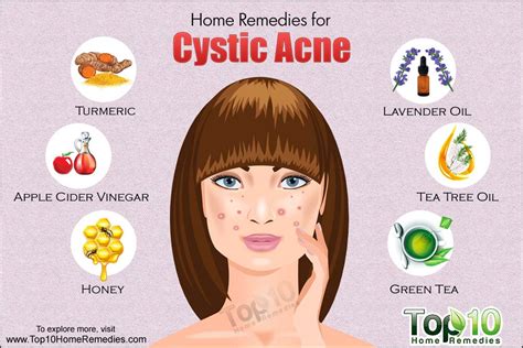 Home Remedies for Cystic Acne | Top 10 Home Remedies