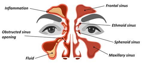 How Long Does Sinusitis Last