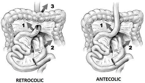 Potential internal herniation sites following Roux-en-Y gastric bypass ...