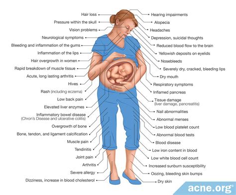 Accutane Birth Defects Caused By