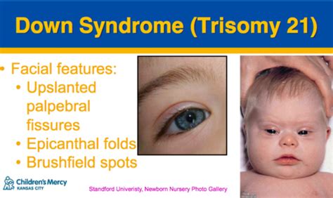 Palpebral Fissures Down Syndrome - Quotes Trending