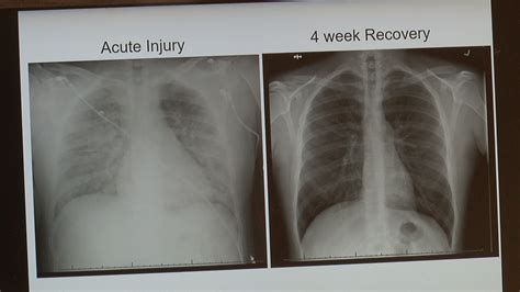 Healthy Lungs Vs Smokers Lungs X Ray