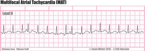 ECG Educator Blog : Multifocal Atrial Pacemaker (MAT)