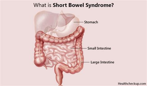 What is Short Bowel Syndrome? Symptoms, Causes and Treatment for SBS