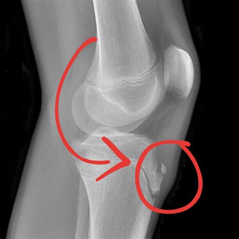 Osgood Schlatter Disease