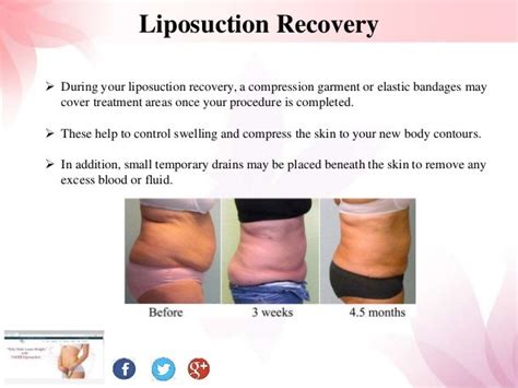 All You Need to Know About Liposuction