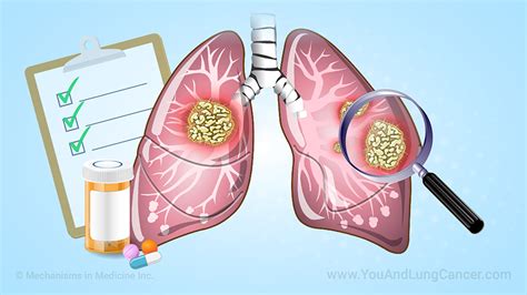 Animation - Understanding Clinical Trials in Lung Cancer