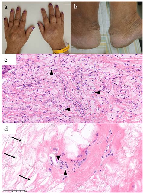 Tendinous Xanthoma Histology