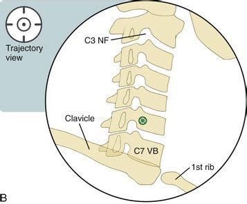 Stellate Ganglion Block | Radiology Key