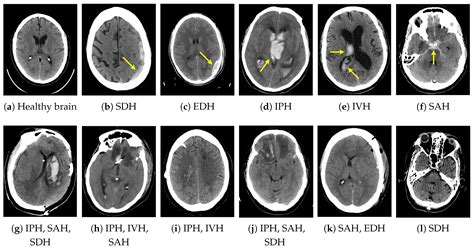 Applied Sciences | Free Full-Text | Intracranial Hemorrhage Detection in Head CT Using Double ...