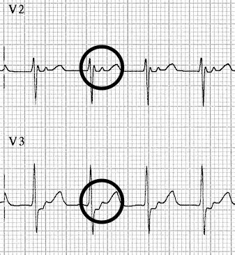 Supraventricular Tachycardia (SVT) • LITFL • ECG Library Diagnosis